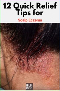 Natural solutions for managing scalp eczema in Black hair. Discover soothing treatments, best products, and prevention strategies for relief. Black Skin Care Routine, Facial Tips, Toxic Skincare, Black Skin Care, Acne Scar, Skin Diseases, Anti Aging Treatments, Skin Repair