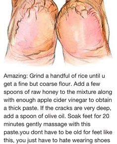 Fix Cracked Heels, Dry Cracked Heels, Home Health Remedies, Cracked Heels, Beauty Remedies, Skin Care Remedies, Body Skin Care Routine, Diy Skin Care, Diy Skin