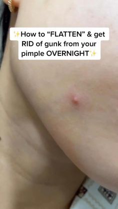 Blind Pimple, Get Rid Of Pimples, Rid Of Pimples, Forehead Acne, Pimples Under The Skin, Medical Words, Pimples Overnight, Natural Acne Remedies, How To Get Rid Of Pimples