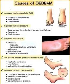 the stages of oedema and how they are used to treat foot pain in children