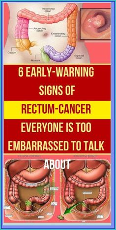 6 early warning symptoms of anal by barbara Walker | This newsletter was created with Smore, an online tool for creating beautiful newsletters for educators, businesses and more Barbara Walker, Sigmoid Colon, Blood Sugar Level Chart, Warning Signs, Blood Sugar, Probiotics, Fitness Tips, Signs