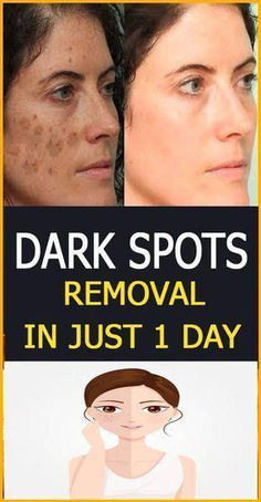 Learn about dark spot treatments that will make you fall in love with your skin all over again. Clear, beautiful skin is within reach!
#LoveYourSkin #ProvenResults #DarkSpotTreatments #SkincareTips #BeautyCare Sun Spots Removal, Dark Spots Removal, Open Pores, Remove Dark Circles, Skin Care Wrinkles