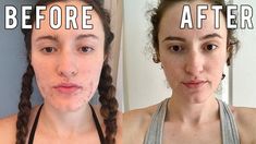 ↓READ MORE ↓In this video, I share my skincare journey with you. I’ve had cystic acne for YEARS. We are talking 14 years. I tried so much with my skincare, t... Acne Prone Skin Care Routine, Clear Skin Fast, Skin Transformation, Acne Prone Skin Care, Benzoyl Peroxide, Skin Routine, Cleansing Oil