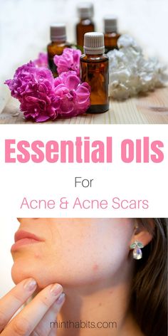 Best essential oils for getting rid of acne and acne scars via @minthabits Essential Oils For Acne, Oils For Acne, Top Essential Oils, Natural Acne, Cold Sores Remedies, Rid Of Acne, Acne Scar Removal, Natural Cold Remedies, Natural Cough Remedies