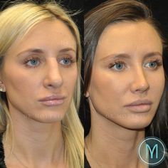 Revision Rhinoplasty, Nose Plastic Surgery, Nose Surgery Rhinoplasty, Rhinoplasty Nose Jobs, Instagram Vs Real Life, Rhinoplasty Surgery, Pretty Nose, Facial Fillers, Perfect Nose