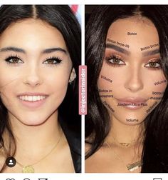 Madison beer Kendall Jenner Plastic Surgery, Face Plastic Surgery, Botox Brow Lift, Botox And Fillers, Botox Before And After, Face Fillers, Eyebrow Lift, Botox Filler, Botox Cosmetic