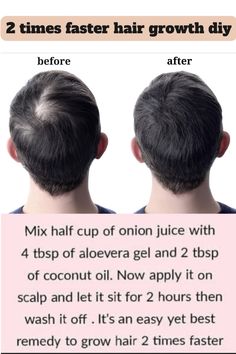 mix half of onion juice with 4tbsp of aloe vera gel  and 2tbsp of coconut oil. apply it on scalp and let sit for 2 hours then wash it of. Stretching Workout, Onion Hair Growth, Healthy Black Hair, Quick Hair Growth, Hair Problem, Hair Solution, Glow Hair, Easy Care Hairstyles, Onion For Hair