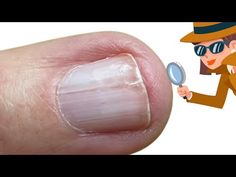 Splitting nail problems [Anna's Nail Advice] - YouTube How To Fix A Split Nail, Split Nails Remedies, Nail Splitting Down The Middle, Splitting Nails Remedies, How To Fix A Split Fingernail, Splitting Fingernails, Nail Advice, Split Toenail