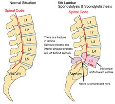 spondylolisthesis 2012 | Copyright © 2012 Kinou Kaifuku Chiropractic Office, All rights ... Lumbar Spondylosis, Nerve Anatomy, Sports Therapy