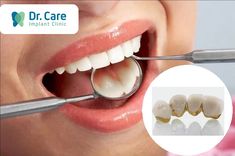 Răng sứ kim loại là gì? Ưu điểm, hạn chế và giá cả | Dr. Care Tooth Infection, Tooth Filling, Dental Fillings, Emergency Dentist, General Dentistry, Harriet Tubman, Dental Procedures, The Big Four, Dental Services