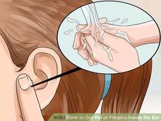 The best medical and natural treatments for ear acneWaking up with a sensitive pimple is frustrating, especially when it's inside your ear! The skin of the ear is just like the skin on any other part of your body. When pores in the ear get... Pimple In Ear, Nose Pimples, Ear Pimple, Inside Ear, Pimples Under The Skin, Cleaning Your Ears