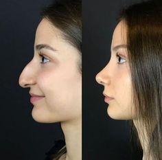 Bad Nose Jobs, Jaw Reduction Surgery, Nose Surgery Rhinoplasty, Ethnic Rhinoplasty, Nose Fillers, Hooked Nose, Plastic Surgery Fail, Rhinoplasty Nose Jobs, Face Surgery