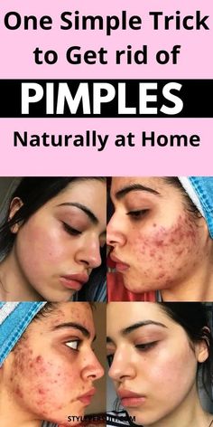 How to Treat Acne Redness, According to Dermatologists Remedies For Pimples On Face, Red Skin Spots, Remedies For Pimples, Pimple Solution, Home Remedies For Pimples, Get Rid Of Pimples, Blind Pimple, Rid Of Pimples, Pimples Under The Skin