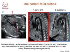 the normal fetal arches are shown in three different pictures