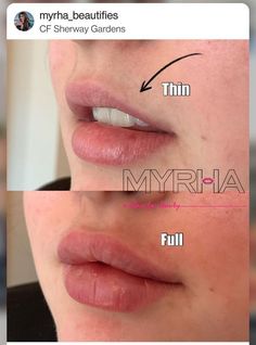 Lip Fillers Round, Lip Filler Bottom Lip Bigger, Lip Filler Downturned Lips, Angelic Lip Filler, Lip Injection Inspiration, Pillow Lips Injections, Lip Fillers Before And After 1ml Russian, Lip Filler Shape Ideas Pouty, M Shaped Lips With Filler