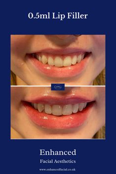 "I'll be smiling all day now" Request for more lip 💋 to be visible when this lovely girl was smiling. Job done ✅ This result was achieved using 0.5ml of premium product. Book now: www.enhancedfacial.co.uk/book #lips #lipfiller #lipfillers #aesthetics #fillers #dermalfiller #dermalfillers #smile #nurseled #nurseledaesthetics #edinburgh #larbert #falkirk #glasgow #cumbernauld #stirling Face Features, Premium Product, Dermal Fillers