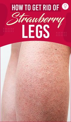 How To Get Rid Of Strawberry Legs: The skin pores on the legs may get congested and form comedones, which appear as dark bumps on your leg, resembling the strawberry skin and seeds. The good news is, you can easily treat strawberry legs at home and prevent the condition. Here is what you need to know. Bumps On Legs, Brown Age Spots, Brown Spots On Skin, Strawberry Legs, Beauty Hacks Skincare, Brown Spots Removal, Brown Spots On Face, Skin Spots, Spots On Face