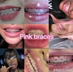 Braces And Glasses Aesthetic, Baby Pink Braces, Braces Pictures, Braces Accessories