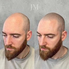 Scalp Micropigmentation Women, Micro Scalp Pigmentation, Skinhead Tattoos, Micro Pigmentation, Cosmetic Procedures, Skin Care Remedies, Price Range, Hair Follicle