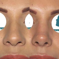 Nose Plastic Surgery, Nose Surgery Rhinoplasty, Nose Job Inspo, Ethnic Rhinoplasty, Nose Fillers, Dream Nose, Rhinoplasty Nose Jobs, Botox Lips, Nose Jobs