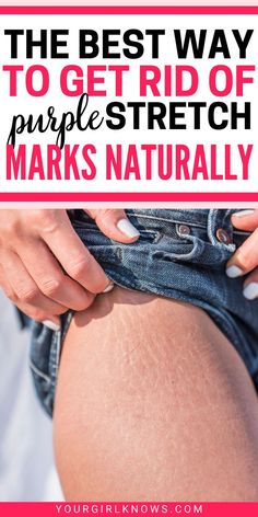 Do you know to remove Purple stretch marks naturally at home? Here's a detailed guide on how to remove stretch marks naturally and make the process faster. Neck Pimples, Pimple Solution, Glowing Skin Overnight, Stretch Mark Remedies, Skincare Routine For Oily Skin, Routine For Oily Skin, Oily Skin Acne, Get Glowing Skin