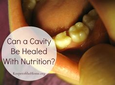 Can a cavitiy be healed with nutrition? Teeth Repair, Homemade Toothpaste Recipe, Teeth Veneers, Remineralize Teeth, Diy Teeth, Canine Teeth, Toothpaste Recipe, Pretty Teeth, Tooth Cavity