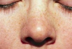 a close up of a person's nose with freckles on their cheeks