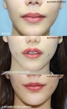 HD Dimple & Lip Surgery www.hyundaisurgery.com Change Appearance, Lip Surgery, Facial Procedure, Plastic Surgery Photos, Face Yoga Facial Exercises, Lip Trends