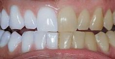 Coconut oil and tumeric to whiten teeth Coconut Oil For Teeth, Teeth Whitening Remedies, Teeth Whitening Diy, Diy Teething, Yellow Teeth, The Teeth, Best Teeth Whitening