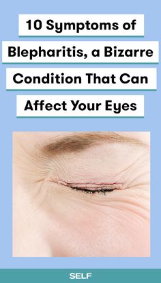 Blepharitis is a funky eyelid inflammation that can happen for a variety of reasons, like a bacterial infection on your eyelids, an allergic reaction to your makeup, or a malfunctioning of the glands that pump oil into your tear film to help your eyes stay moisturized. Here are the major blepharitis symptoms you should know. Prostate Health Men, Libido Boost, Home Remedies For Skin, Men Over 50, Dry Eyes Relief, Dry Eye, Eye Exercises, Sore Eyes, Eyes Problems