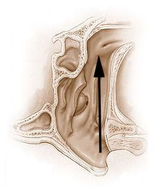 Intranasal Treatment for Clogged Ears | Fauquier ENT Blog Eustachian Tube Dysfunction, Reflexology Pressure Points, Clogged Ears, Ear Drops, Ear Health, Nasal Spray, Health Articles, Health Info, Home Health