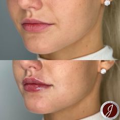 Upper Lip Filler, Light Lip Filler, Natural Lip Fillers 0.5ml, Pouty Lip Filler, 0.5ml Lip Filler Before And After, Natural Lip Fillers, Remove Upper Lip Hair Naturally, Remove Upper Lip Hair