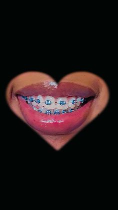 Color Of Braces, Orange Braces, Dark Blue Braces, Bracket Colors, Brace Ideas