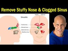 Stuff Nose Remedies Nasal Congestion, Sinus Infection Relief How To Get Rid, How To Unclog Nose, How To Get Rid Of A Stuffy Nose Fast, Clogged Nose Remedy, Sinus Pressure Relief Fast, Stuff Nose Remedies, How To Unblock Nose, Clogged Nose