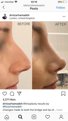 Nose Job Inspiration, Nose Fillers