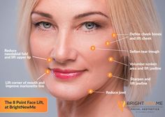 The 8-Point Face Lift for a refreshed, rejuvenated look 8 Point Face Lift, Facial Veins, Marionette Lines, Anti Wrinkle Injections, Plasma Pen