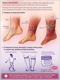 an info poster describing how to treat foot pain