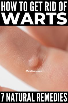 Warts On Hands, Warts On Face, Home Remedies For Warts, Remove Skin Tags Naturally, Warts Remedy, Be Uncomfortable, Get Rid Of Warts, Home Remedy For Cough, Skin Natural Remedies