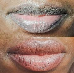 Candy Lips, Dental Design, Facial Aesthetics, Love Lips, Makeup Board, Dark Lips, Skin Issues, Permanent Makeup, Cosmetology