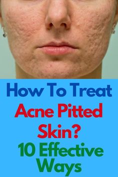 How To Treat Acne Pitted Skin? 10 Effective Ways What Helps With Acne Scarring, Pitted Acne Scar Removal, How To Fix Acne Scarring, Acne Pit Scars, Cystic Acne Remedies, Acne Overnight, Pimples Remedies