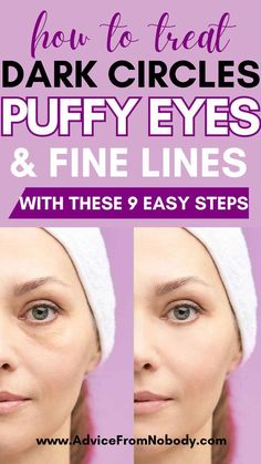 Usually, a cosmetic issue, bags under the eyes don't need to be treated. Eye Bags Remedy, Tired Eyes Remedy, Undereye Bags Remedy, Get Rid Of Eye Bags, Big Brows, Rid Of Eye Bags, Eye Bag Remedies, Best Under Eye Cream, Puffy Eyes Remedy