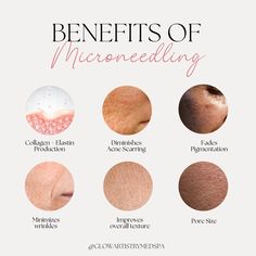 Benefits Of Microneedling, Glowing Skin, Wrinkles, Facial, Benefits, Acne, Skin, Quick Saves