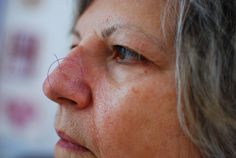 Basal Cell On Face, Bioplasma Cell Salts Benefits, Mohs Skin Surgery, Basil Cell Carcinoma, Skin Disease Pictures, Lobular Carcinoma Invasive, Smooth Muscle Histology, Invasive Ductal Carcinoma