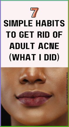 acne prone skin care, acne skincare routine simple, how to get rid of adult acne, how to get rid of acne naturally, acne and pimples home remedies, home remedies for acne, how to get clear skin, cystic acne treatment, how to get rid of acne as an adult, how to remove cystic acne, how to get rid of acne marks, how to get rid of acne naturally, how to clear skin, acne glow up, acne night routine How To Remove Forehead Acne, Remove Acne Marks On Face, How To Get Rid Of Acne Marks, Acne Marks Remedies, Clear Your Skin, Home Remedies For Pimples, Acne Prone Skin Care, Skin Aesthetics, Acne Skincare