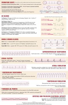 Cardiac Monitor Tech, Cath Lab Technician, Paramedic Cardiology, Nursing School Studying Cheat Sheets, Nurse Teaching, Medical Assistant Student, Paramedic School