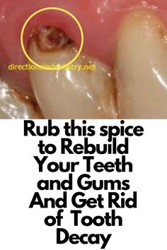 Dental Remedies, Teeth Decay, Fix Teeth, Teeth Remedies, Tooth Cavity, Tooth Repair