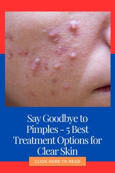 Say Goodbye to Pimples - 5 Best Treatment Options for Clear Skin Skincare Transformation, Skincare Solutions, Acne Free Skin, Healthy Skin Tips, Whats Good