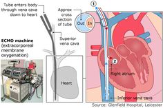 an image of the heart and ventilator in this medical infoal poster about how it works