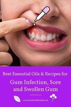 Swollen Gums Remedy, Gum Sores, Reverse Receding Gums, Essential Oils Recipes, Tooth Infection, Gum Inflammation, Swollen Gum, Teeth Health, Receding Gums