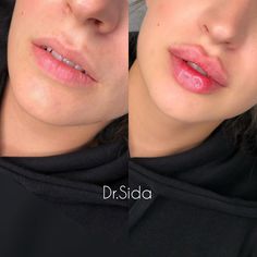 Hailey Bieber Lip Filler, Selena Gomez Lips Fillers, Russian Lips Filler 1ml, 0.5ml Lip Filler Before And After, Madison Beer Lips Before And After, Lip Fillers Juvederm, Dermal Fillers Lips, Face Fillers